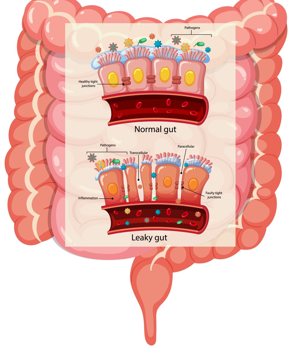 Normal versus leaky gut lining diagram illustrating the gut-immune connection in allergy care — Ronen Rosenblatt Nir acupuncture, Boca Raton