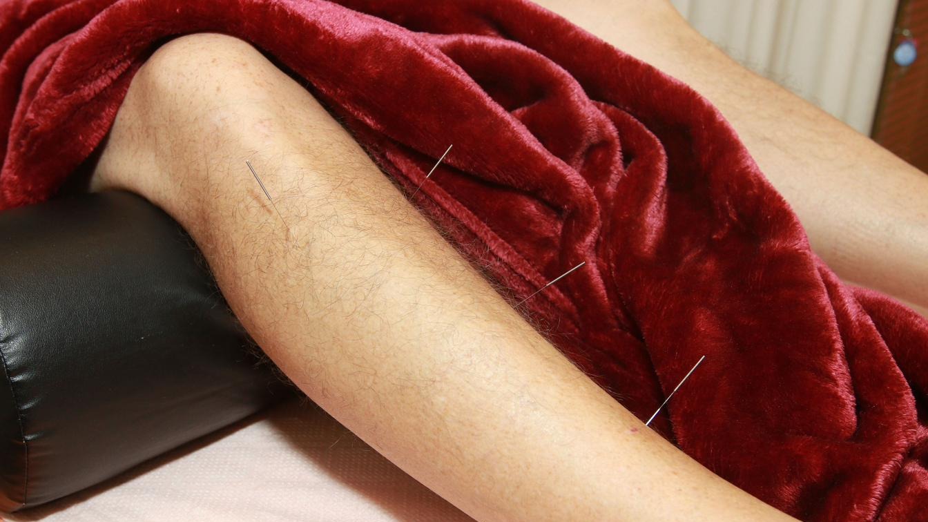 Multiple acupuncture needles placed in patient's leg to treat back pain — distal acupuncture technique at Ronen Acupuncture Boca Raton