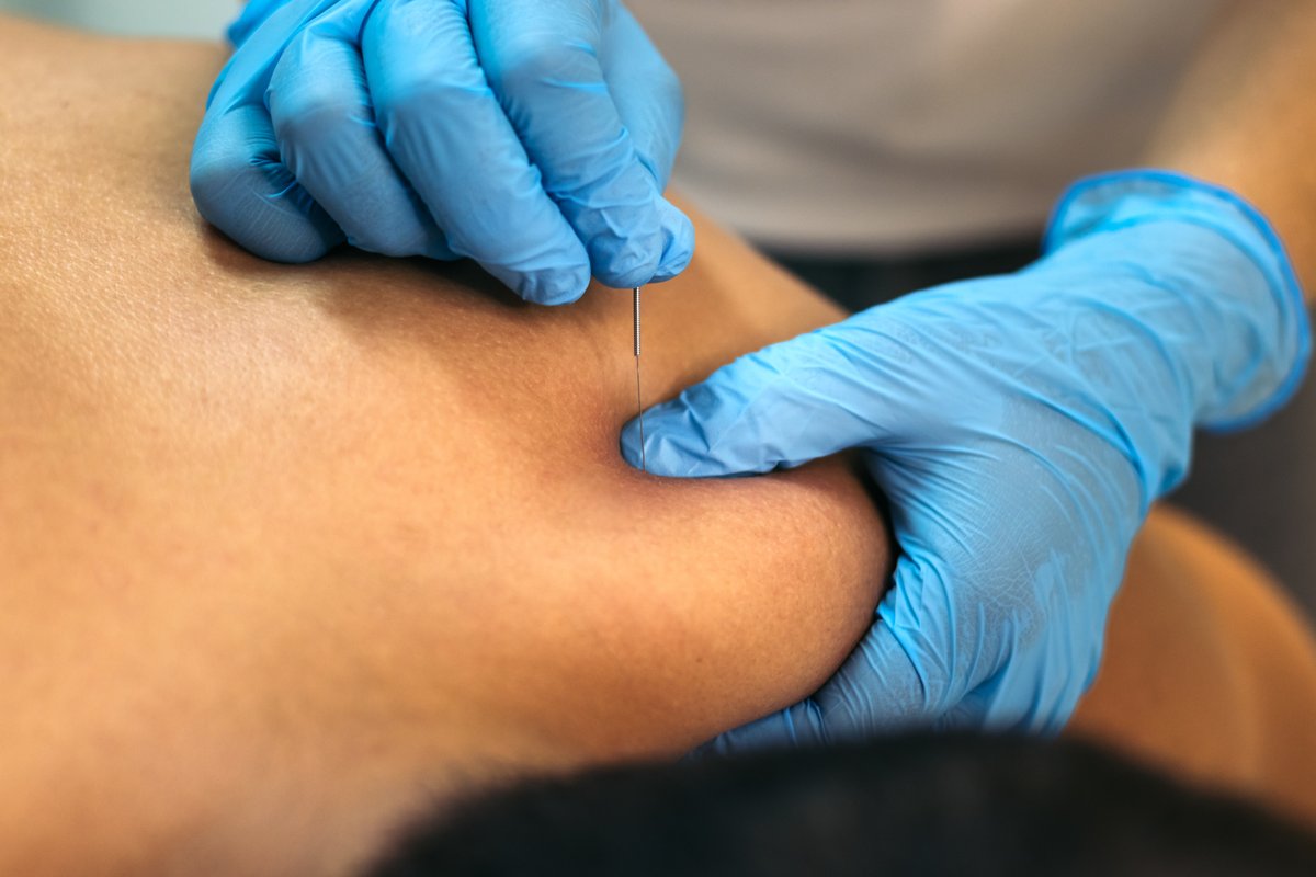 Close-up of gloved hands inserting a dry needling filiform needle into a knee trigger point, Rosenblatt Acupuncture Boca Raton