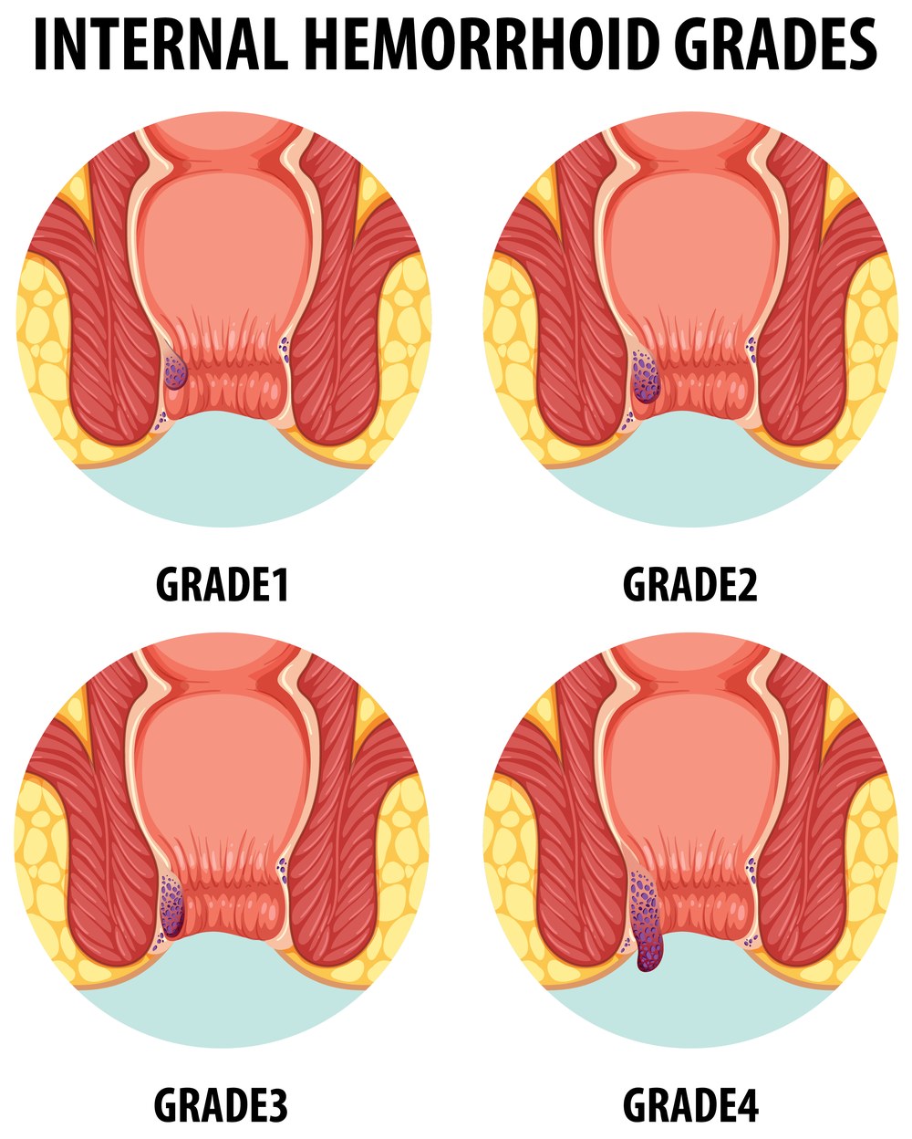 Diagrama dos graus 1 a 4 de hemorroidas internas — a classificação orienta as decisões de acupuntura e cuidado conservador, Boca Raton