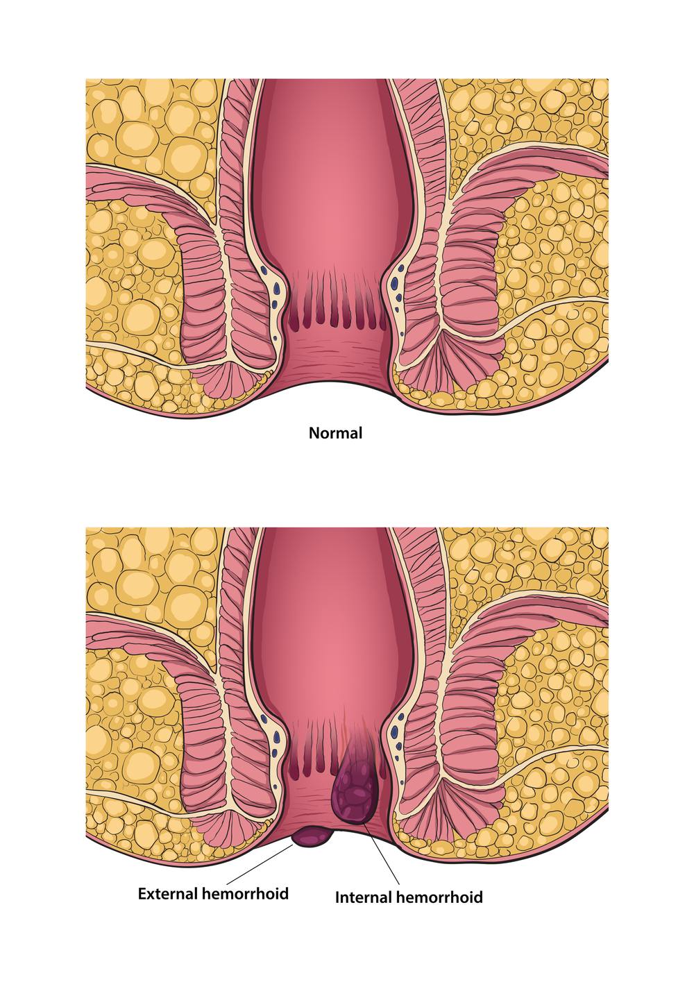 Diagrama de hemorroidas internas e externas — anatomia relevante ao tratamento de acupuntura para hemorroidas, Boca Raton