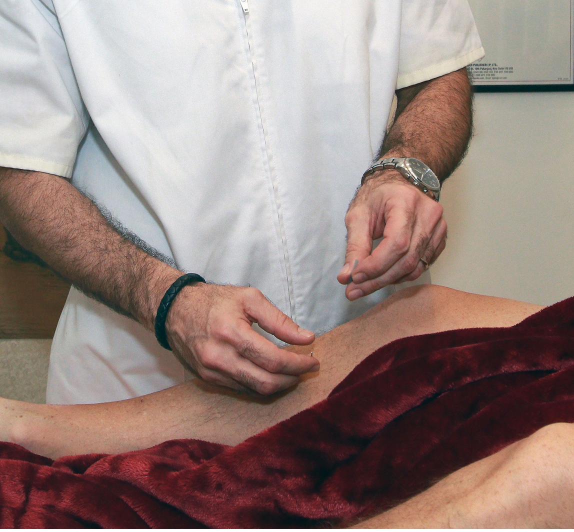 Acupuncture treatment for back pain using distal points at Ronen Acupuncture Boca Raton