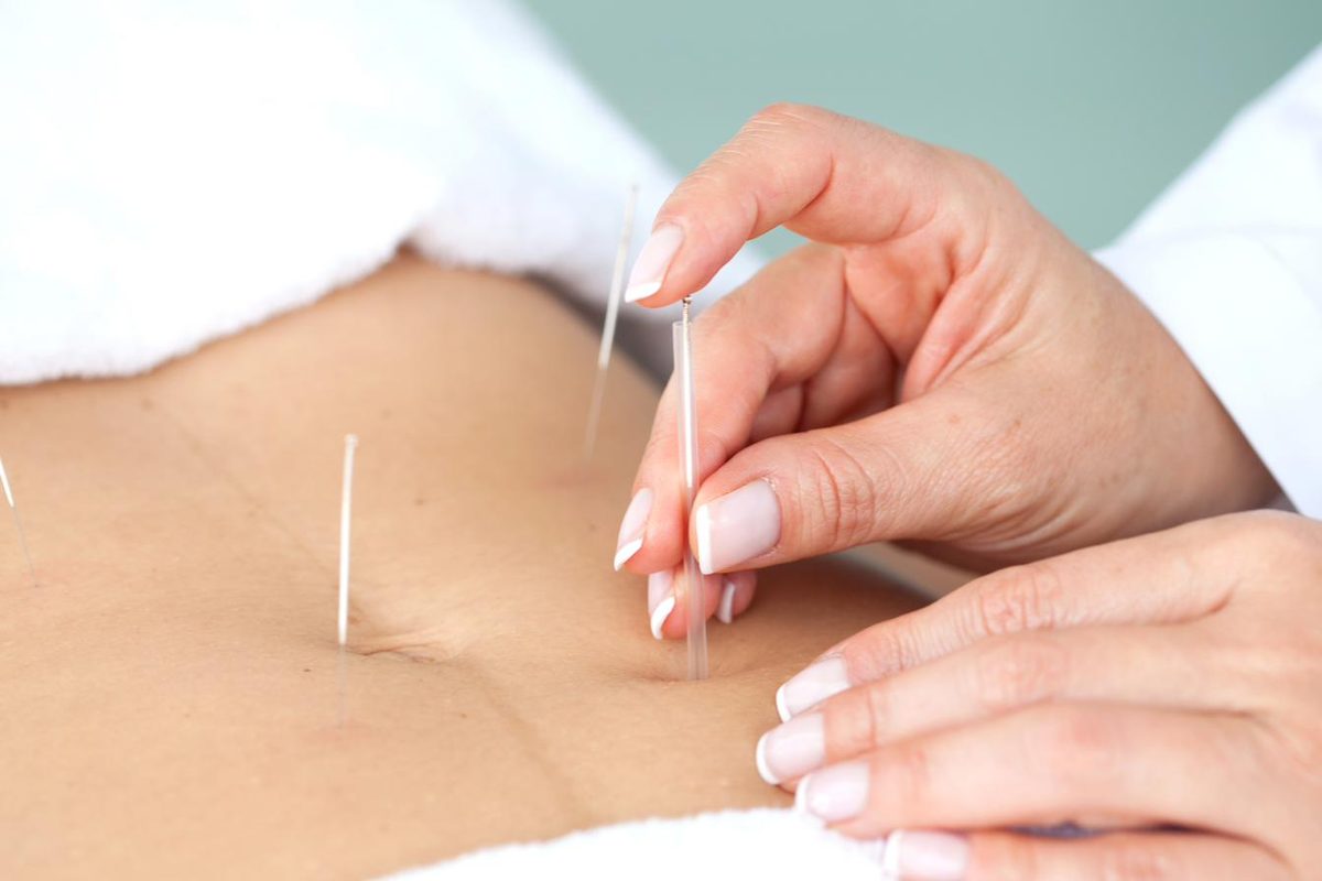 Acupuncture needles placed at the lower abdomen during treatment for menstrual pain — Ronen Acupuncture Boca Raton, Ronen Rosenblatt Nir