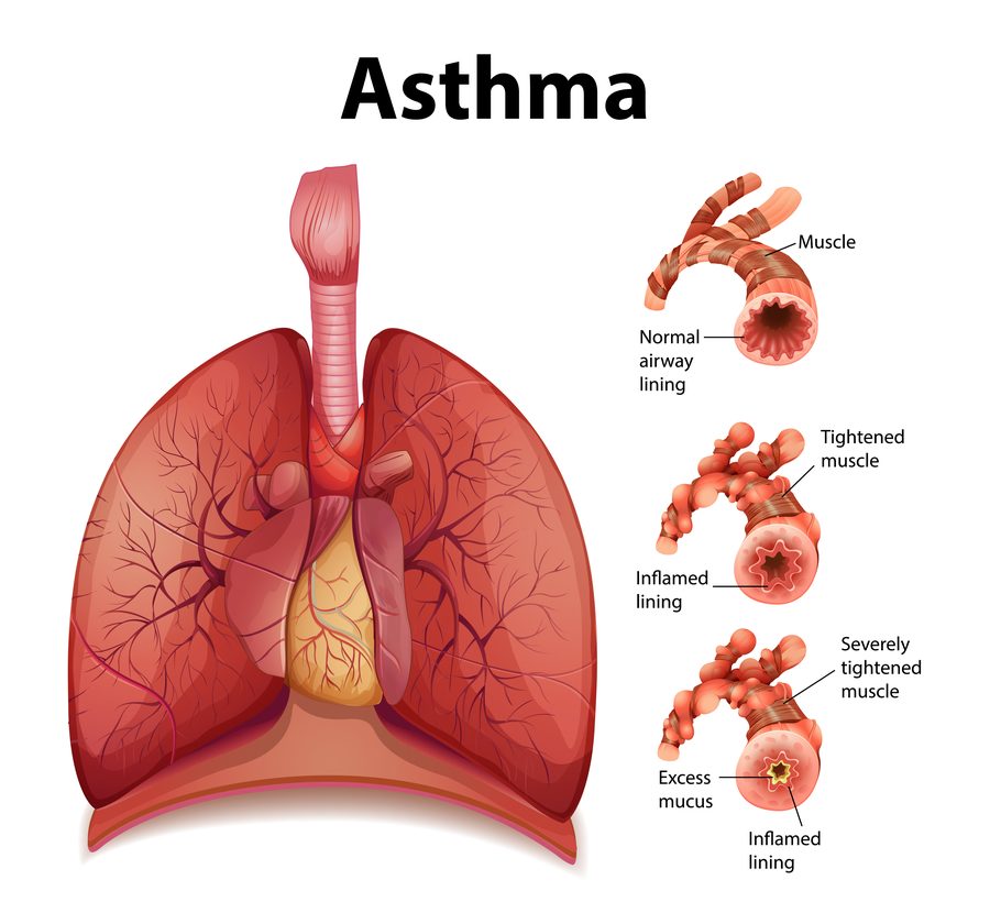 Asthma lungs progressive inflammation normal inflamed airways muscle tightening excess mucus
