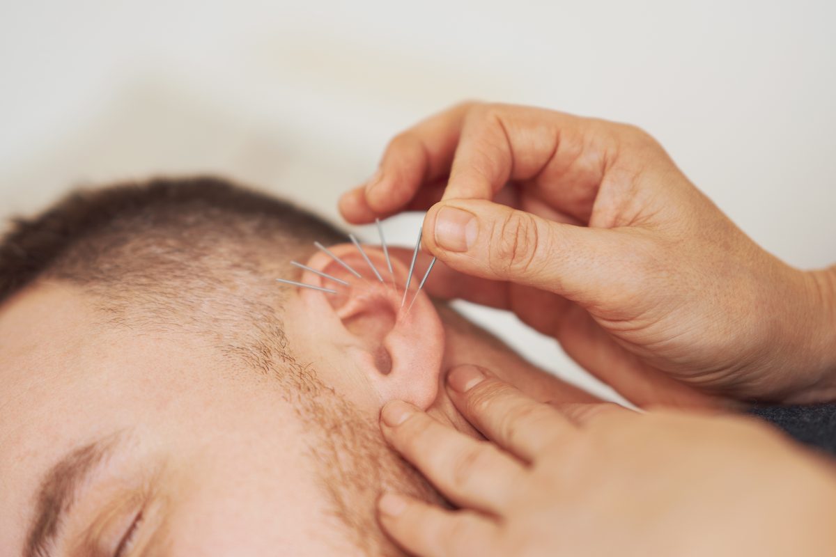 Auricular acupuncture showing needles in ear treatment points - Ronen Rosenblatt Nir, Acupuncturist Boca Raton
