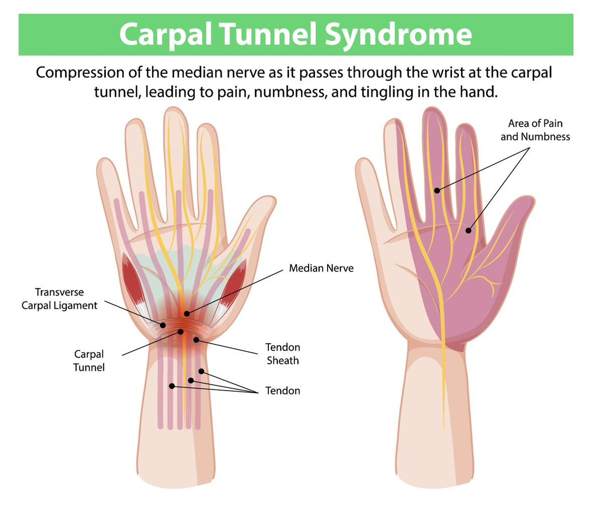 Carpal tunnel syndrome anatomy diagram showing the median nerve compressed by the transverse carpal ligament at the wrist, with areas of pain and numbness in the hand — carpal tunnel acupuncture Boca Raton, Ronen Rosenblatt Nir