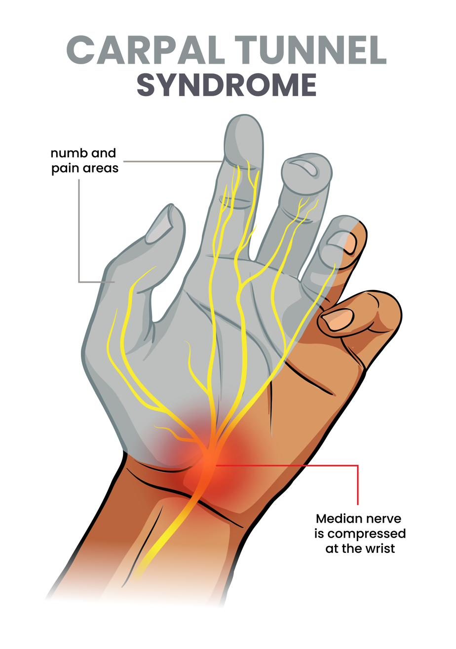 Illustration of carpal tunnel syndrome showing numb and pain areas in the fingers and the median nerve compressed at the wrist — carpal tunnel acupuncture Boca Raton, Ronen Rosenblatt Nir