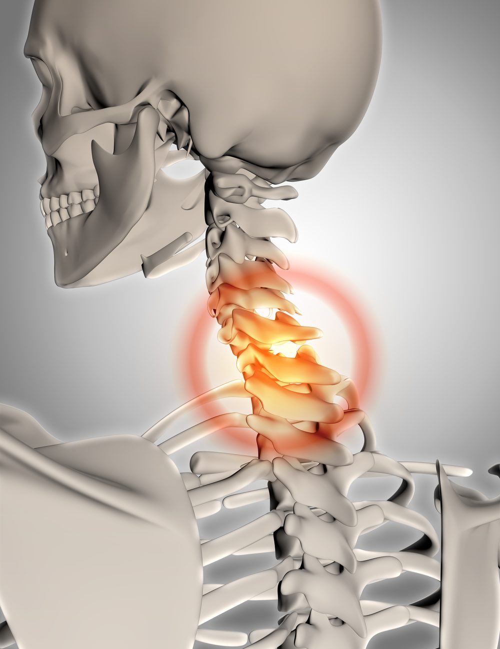 3D illustration of the cervical spine with an inflamed neck segment — acupuncture for cervical disc herniation and neck pain in Boca Raton by Ronen Rosenblatt Nir
