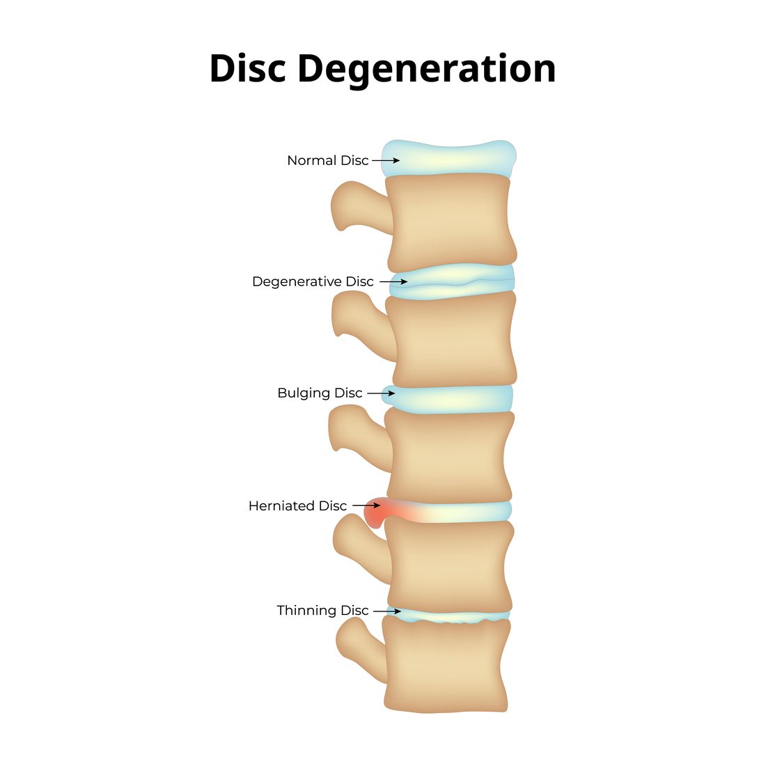 Disc degeneration stages diagram — normal, degenerative, bulging, herniated, and thinning discs — acupuncture for herniated and bulging disc in Boca Raton by Ronen Rosenblatt Nir
