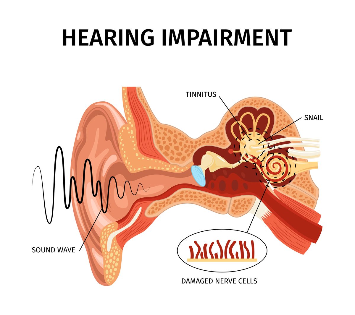 Ear anatomy showing inner ear structures involved in tinnitus