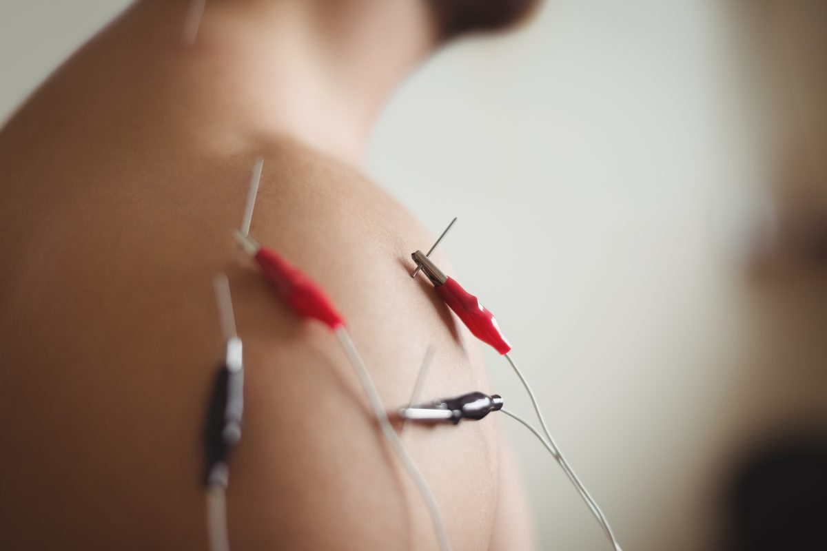 Electroacupuncture treatment with electrical stimulation on needles - Advanced acupuncture pain relief technique