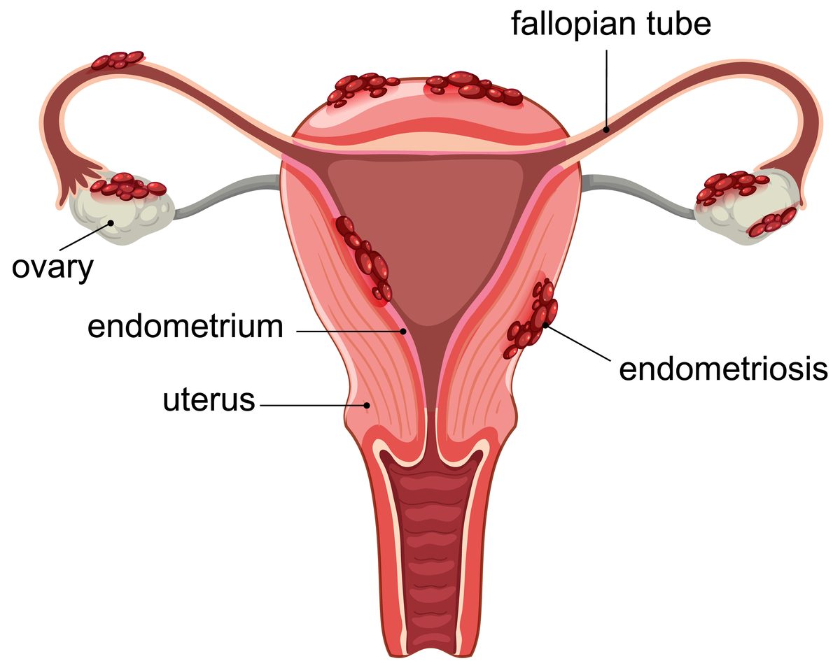 Diagrama anatômico da endometriose mostrando ovários, trompas de Falópio e lesões | Tratamento com acupuntura por Ronen Rosenblatt Nir, Boca Raton