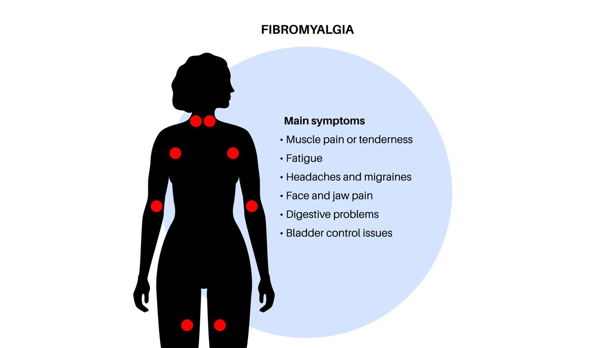 Diagram of common fibromyalgia pain areas and main symptoms on a female body — acupuncture for fibromyalgia in Boca Raton by Ronen Rosenblatt Nir