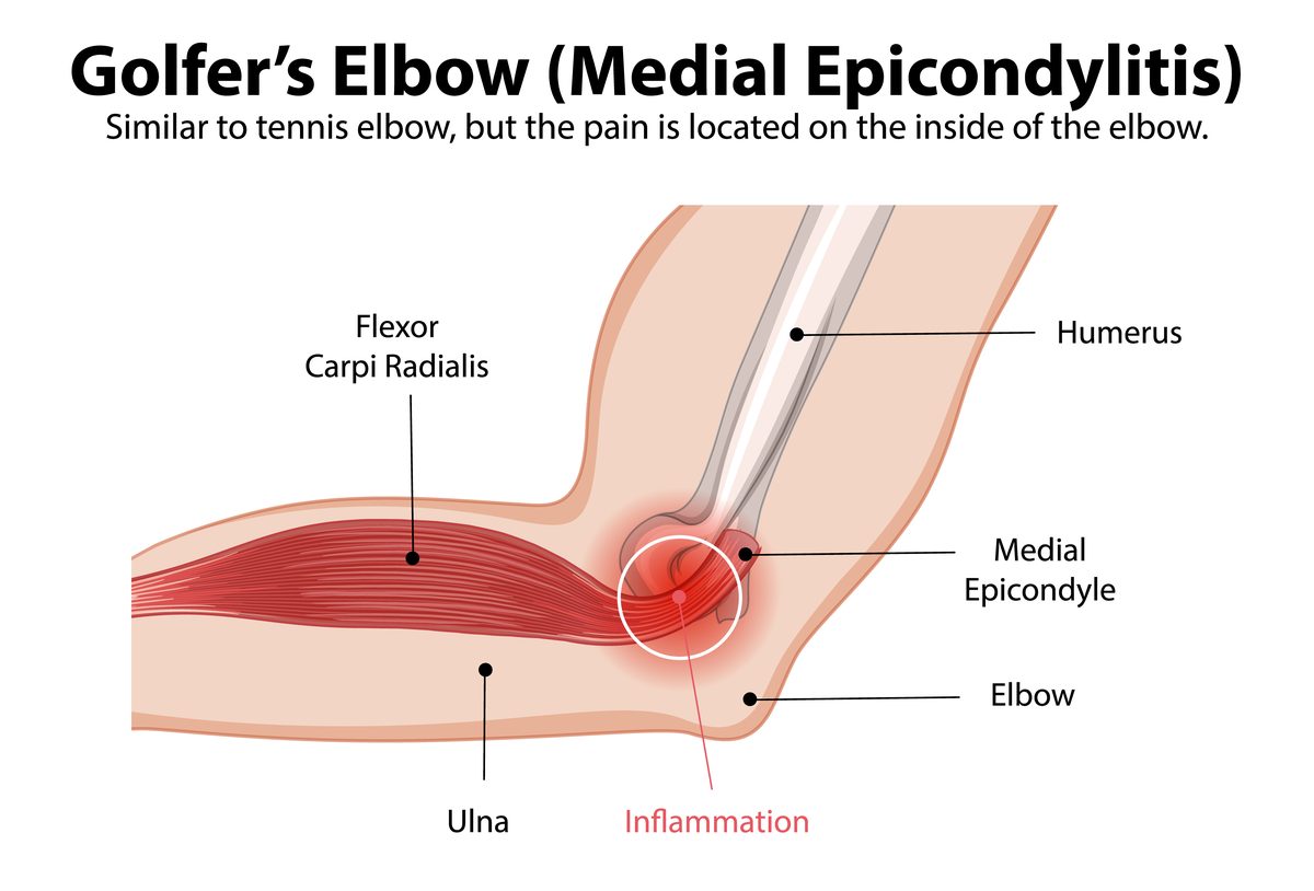 Golfer's elbow medial epicondylitis anatomy diagram showing the flexor carpi radialis, humerus, medial epicondyle, ulna, and inflammation on the inner elbow — golfer's elbow acupuncture Boca Raton, Ronen Rosenblatt Nir