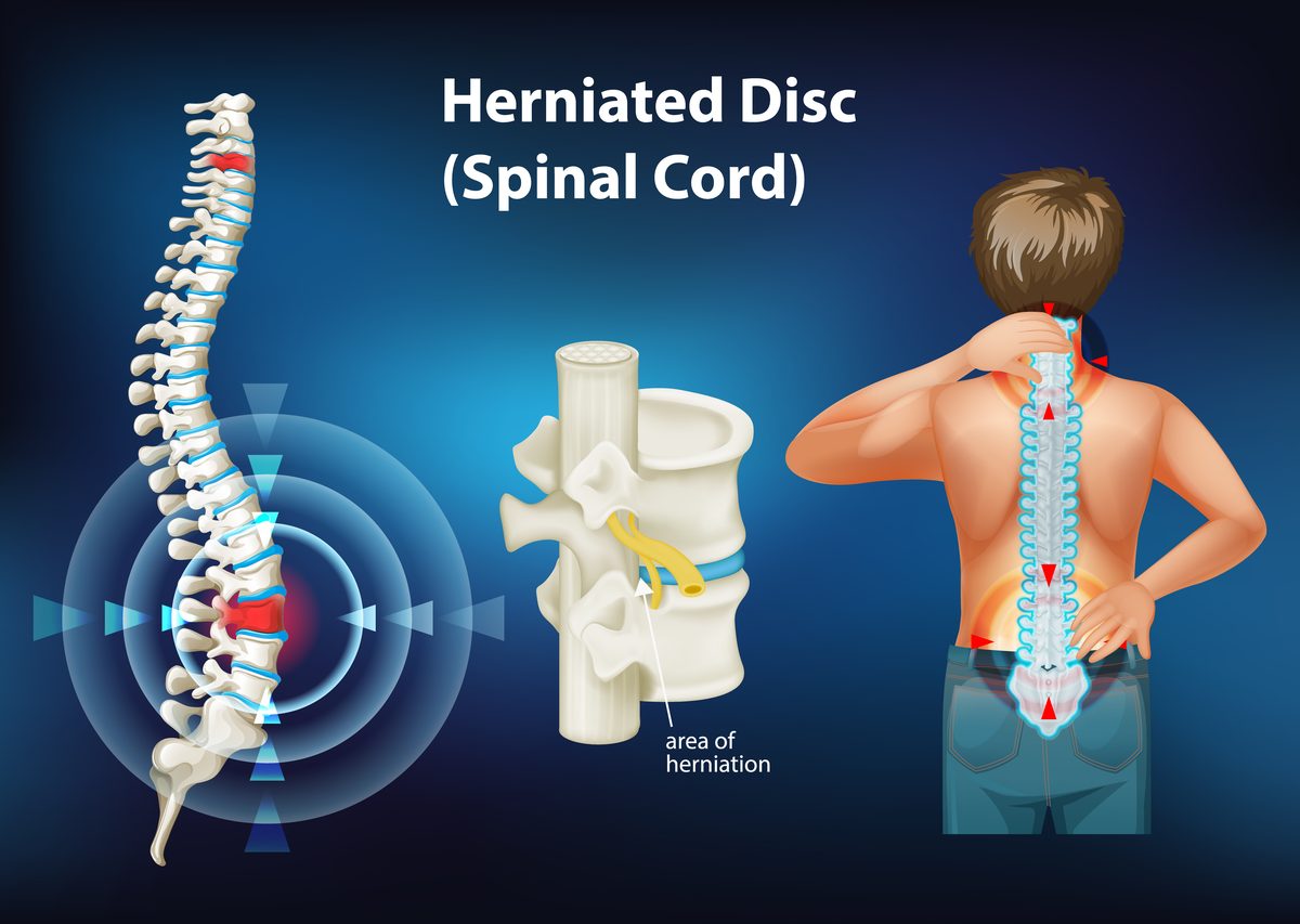 Herniated disc illustration showing spine pain treated with acupuncture in Boca Raton