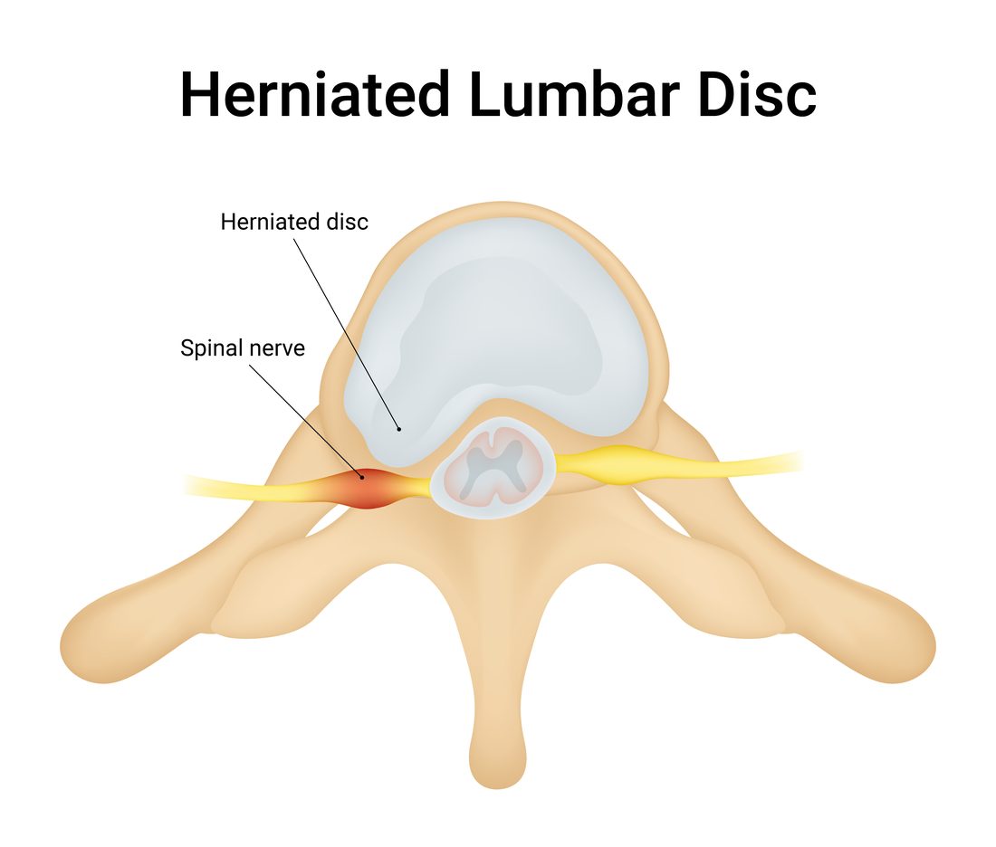 Cross-section diagram of a herniated lumbar disc pressing on a spinal nerve root — acupuncture for herniated disc in Boca Raton by Ronen Rosenblatt Nir