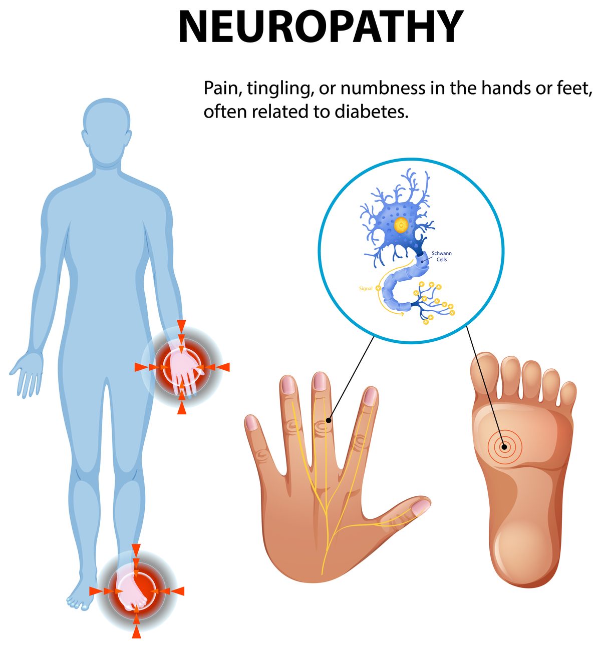 Medical diagram of peripheral neuropathy showing pain, tingling and numbness in the hands and feet with nerve cell and Schwann cells detail — acupuncture for neuropathy Boca Raton, Ronen Rosenblatt Nir
