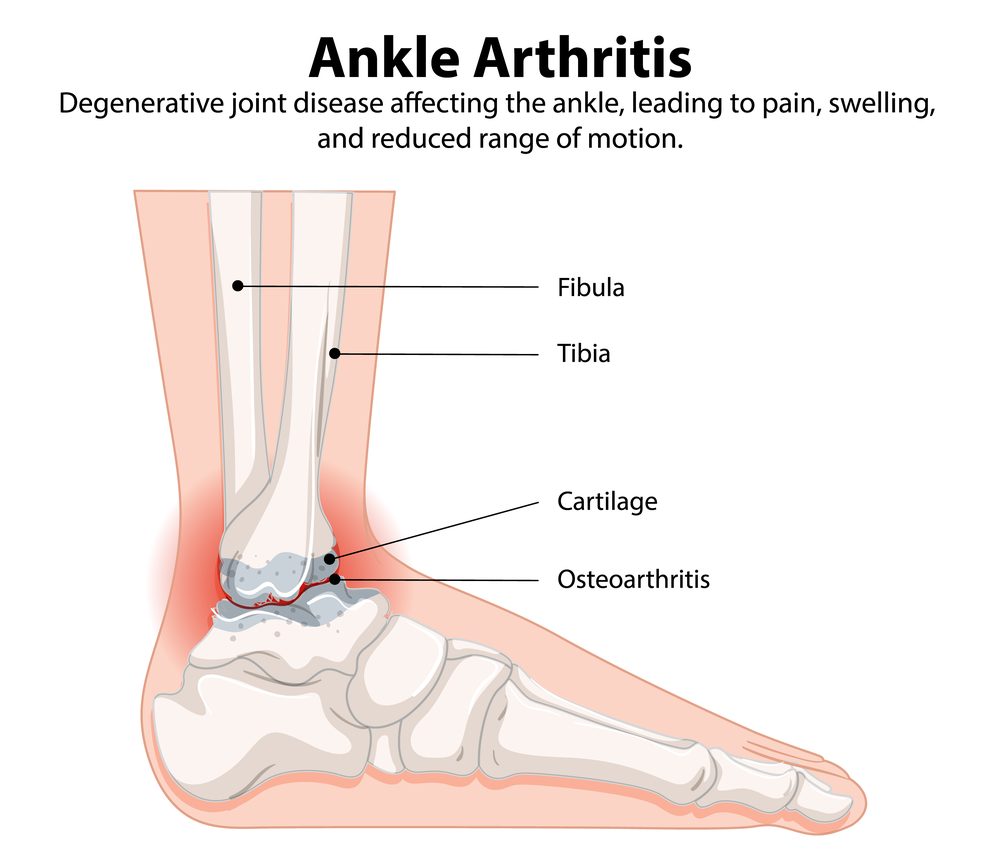 Ankle arthritis anatomy showing cartilage degeneration and osteoarthritis changes