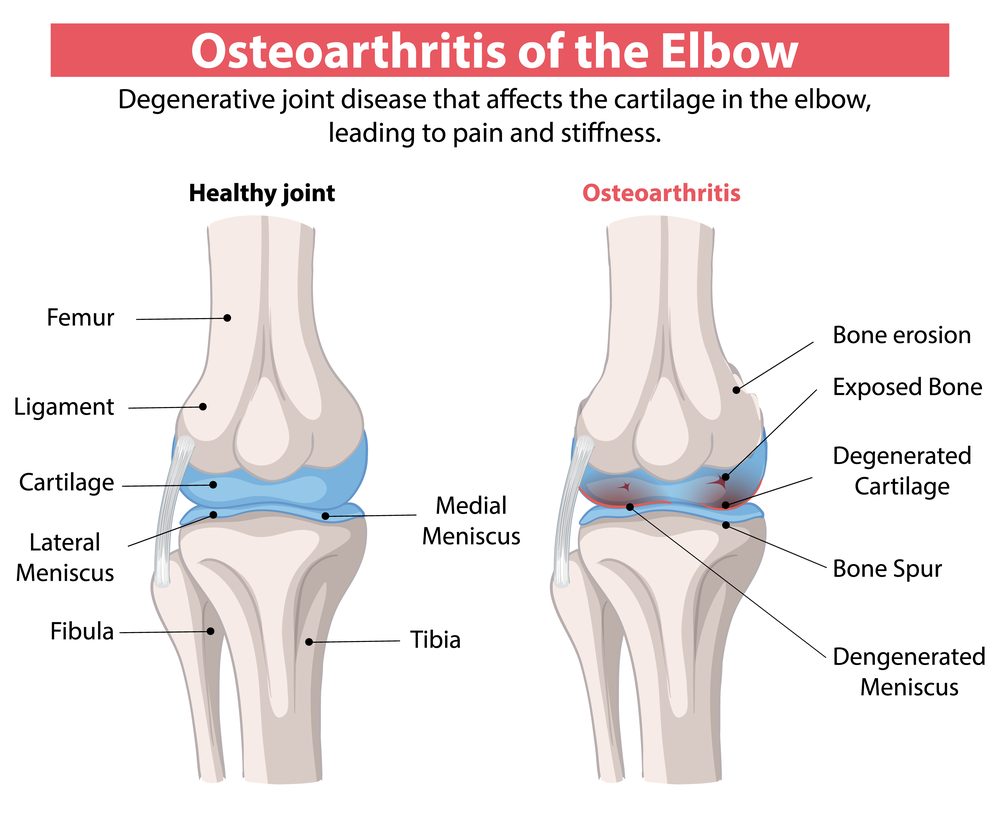 Elbow osteoarthritis anatomy showing healthy joint compared to degenerated cartilage and bone erosion