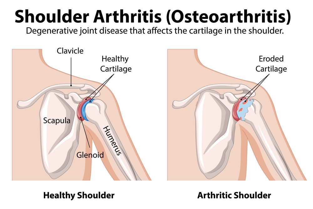 Shoulder osteoarthritis anatomy showing healthy shoulder compared to eroded cartilage in arthritic shoulder