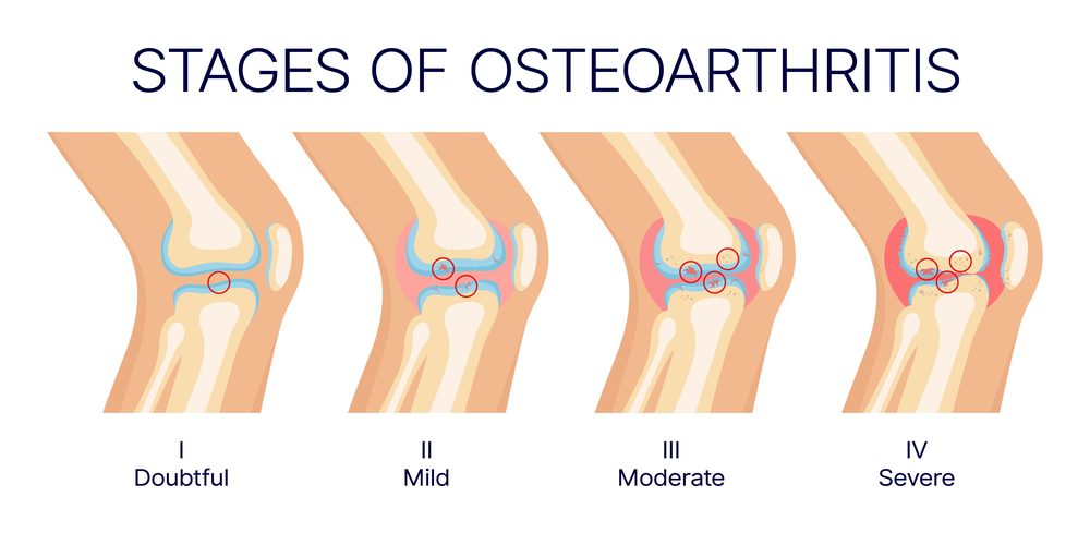 Four stages of osteoarthritis progression from doubtful to severe joint degeneration