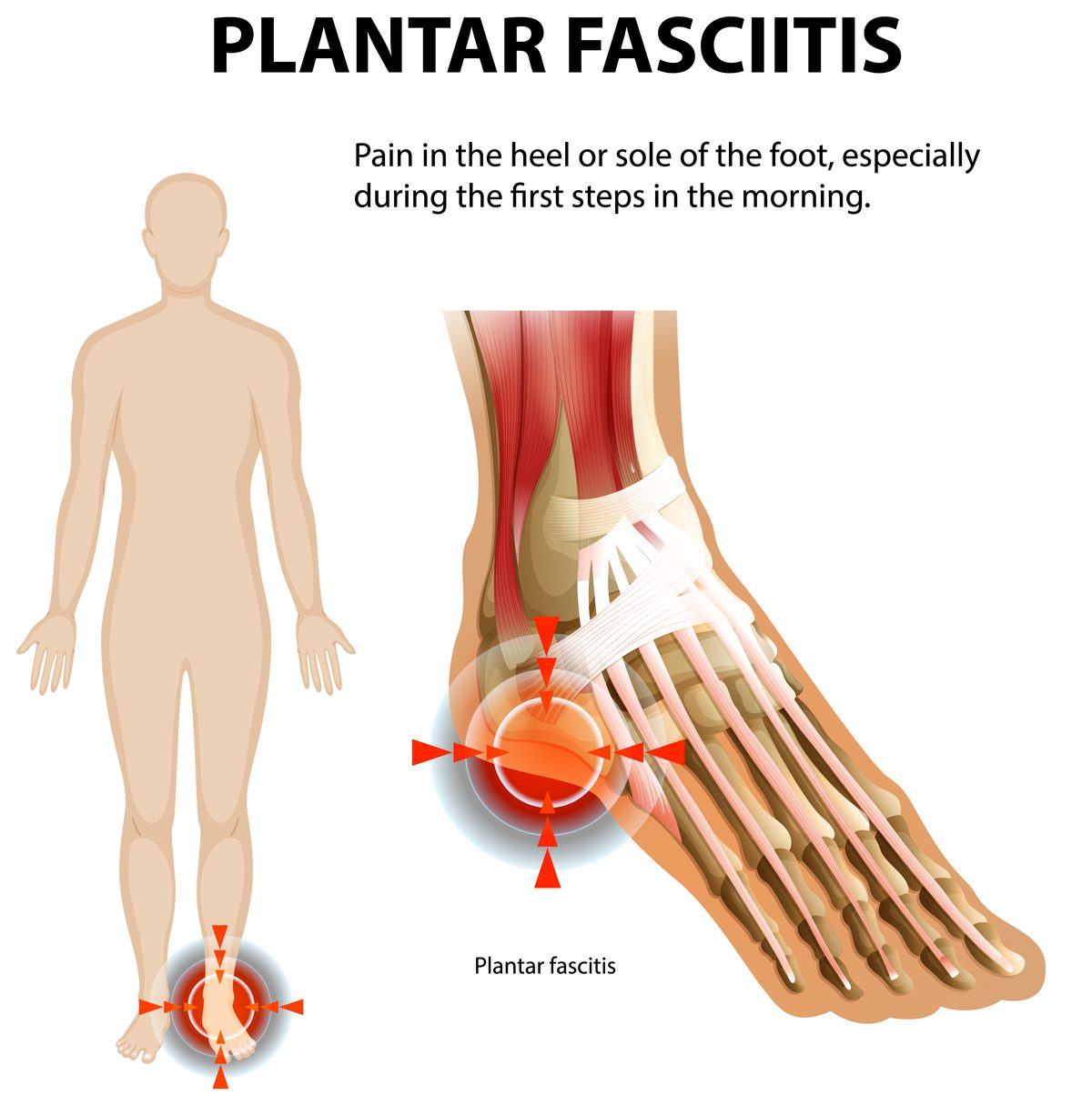 Plantar fasciitis anatomy diagram showing the inflamed plantar fascia and pain point at the heel of the foot — acupuncture for plantar fasciitis Boca Raton, Ronen Rosenblatt Nir