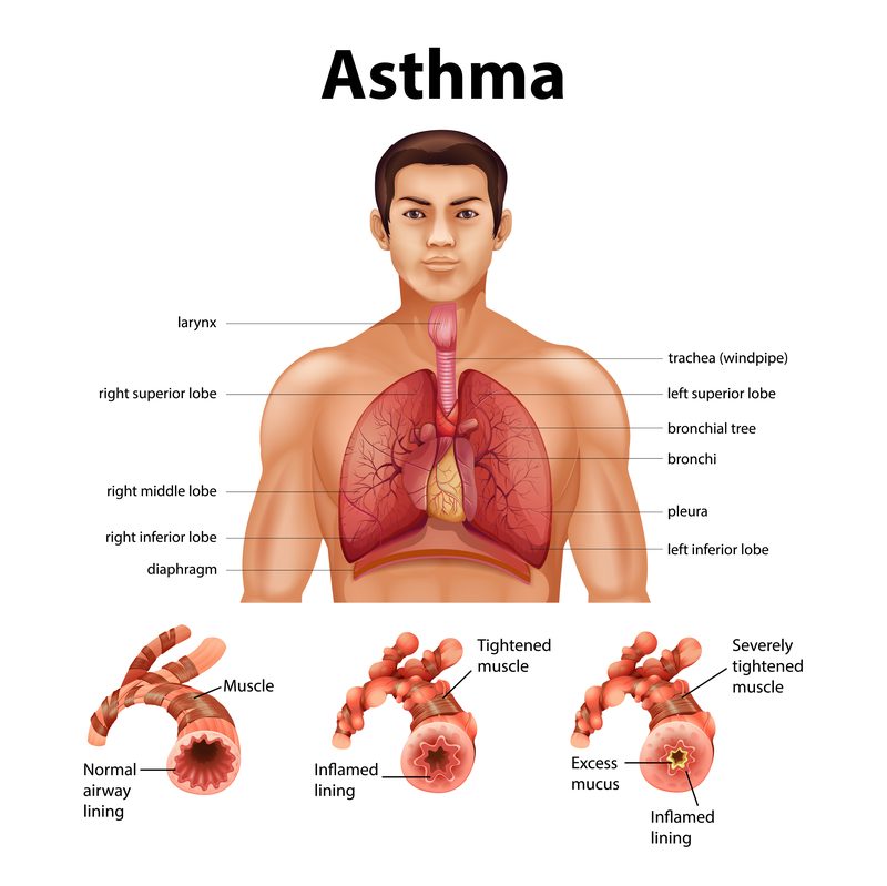 Respiratory system asthma airway inflammation anatomy bronchial tubes normal inflamed