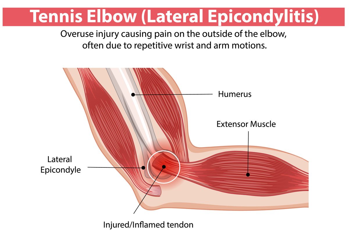 Tennis elbow lateral epicondylitis anatomy diagram showing the humerus, extensor muscle, lateral epicondyle, and injured inflamed tendon on the outer elbow — tennis elbow acupuncture Boca Raton, Ronen Rosenblatt Nir