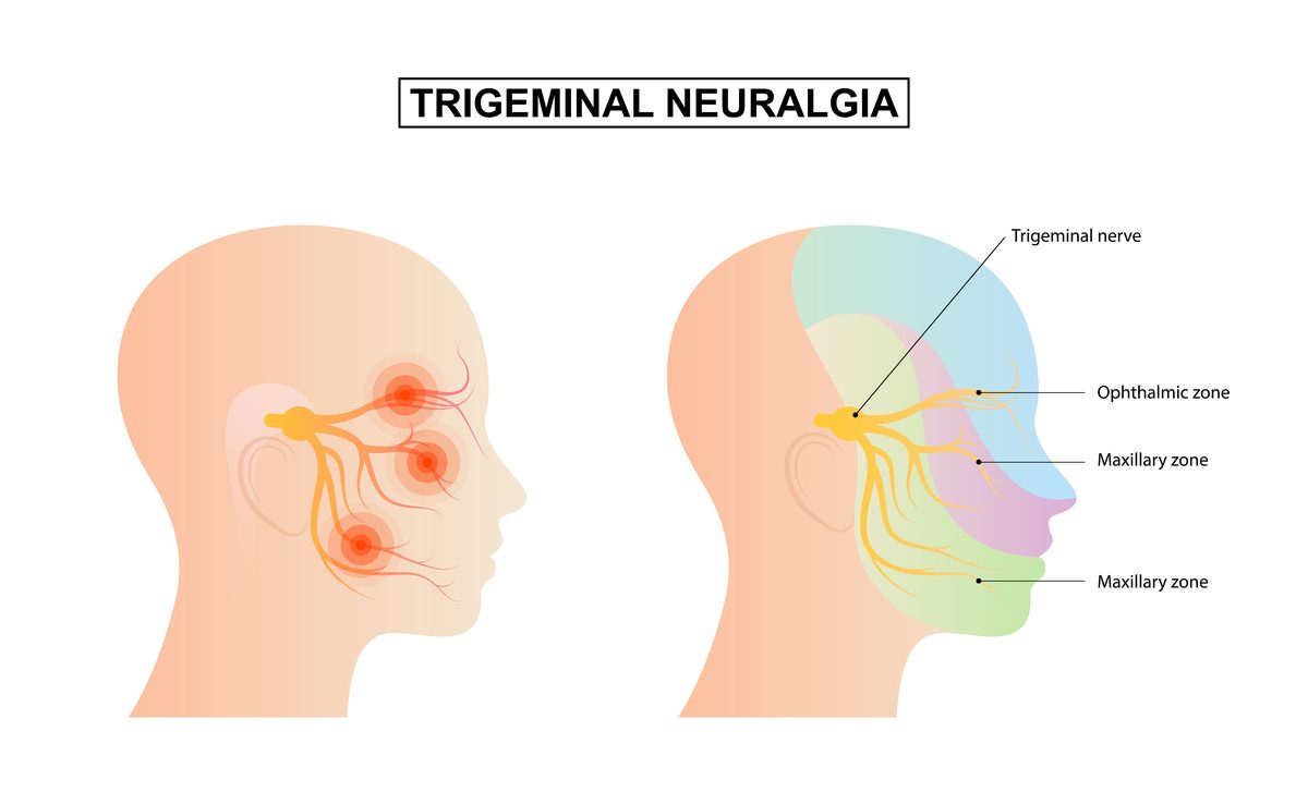 Trigeminal neuralgia diagram showing the trigeminal nerve and its ophthalmic, maxillary and mandibular zones with facial pain points — acupuncture for trigeminal neuralgia Boca Raton, Ronen Rosenblatt Nir